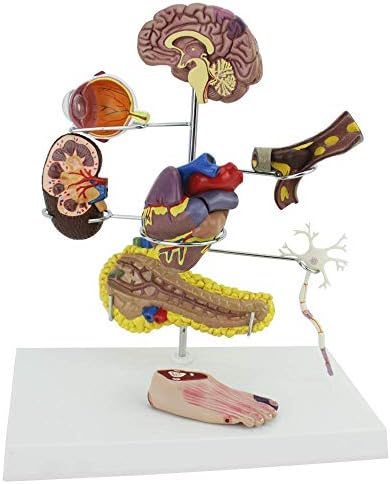 Oktatási Modell, Anatómiai Modell, Az Emberi Anatómia - Kóros Cukorbetegség Modell Cukorbeteg Szerv Anatómiai Modell,